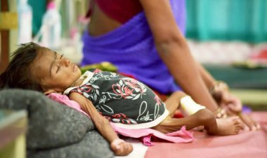 कुपोषण रोकने में असफल विभागों के प्रयास