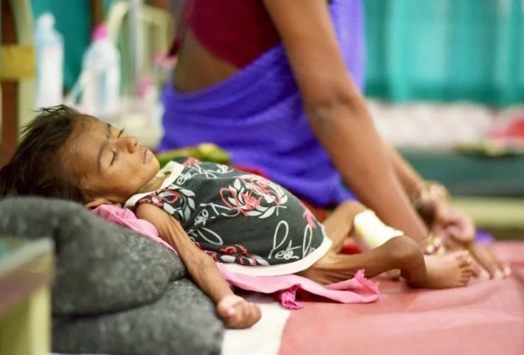 कुपोषण रोकने में असफल विभागों के प्रयास