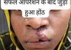 सफल सर्जरी से भीमे हेमला के चेहरे पर लौटी मुस्कान